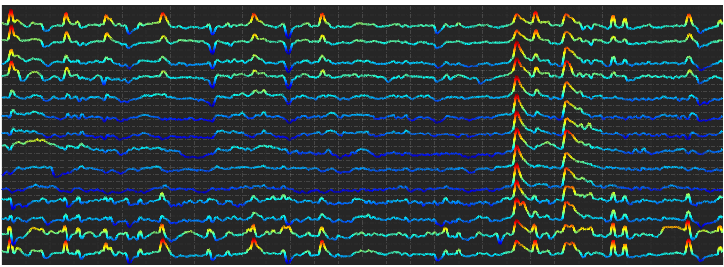 Autonomous vechicle microsleep detector Vol3: Misclassification tradeoff